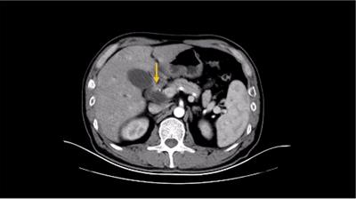 Case Report: A case of advanced duodenal adenocarcinoma in complete remission after chemotherapy combined with targeted therapy and radiotherapy